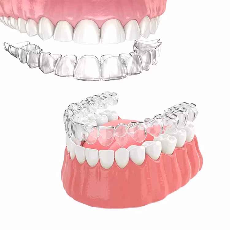 Aligner Treatment