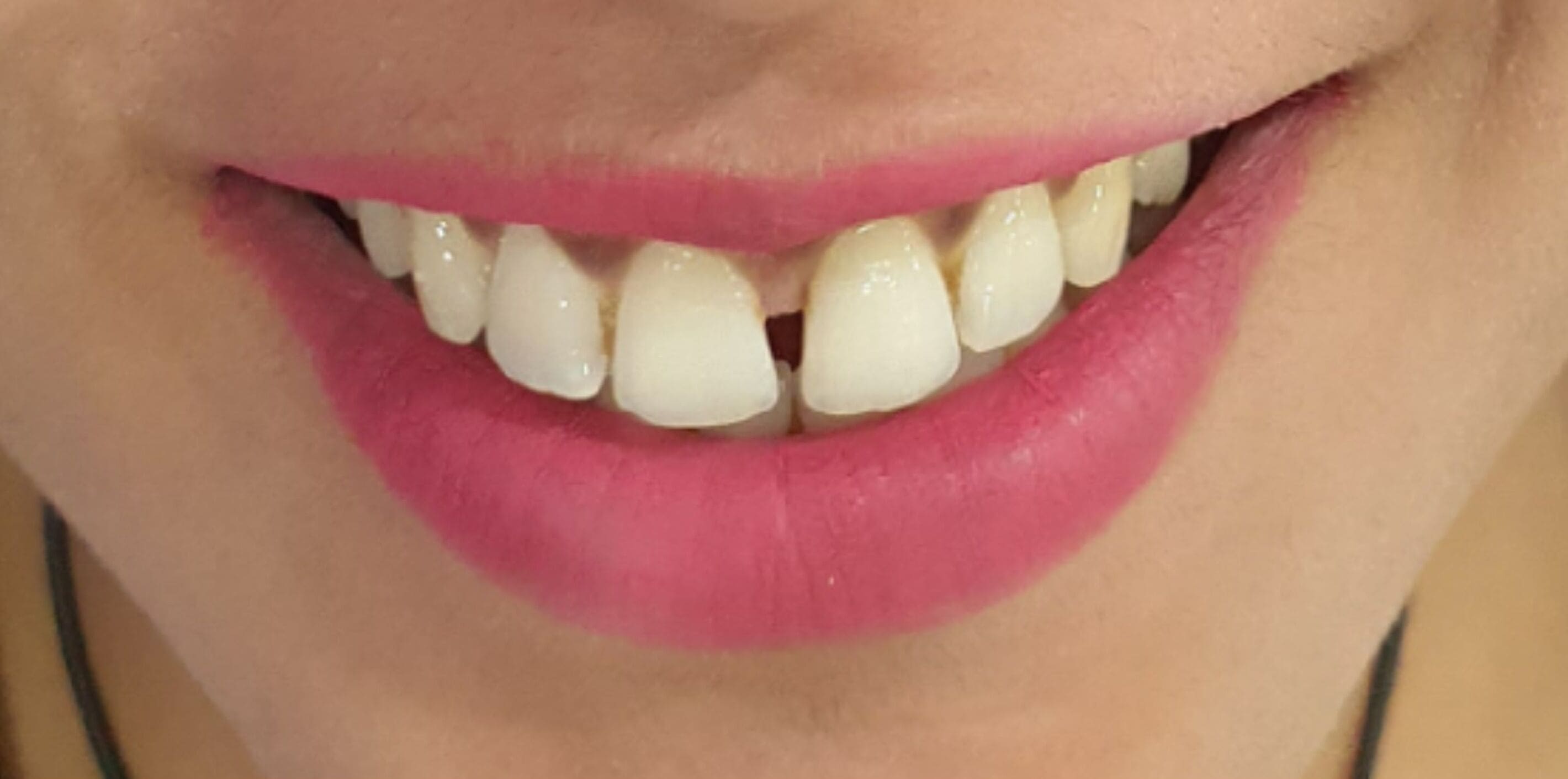 Before Dental Esthetics Treatment
