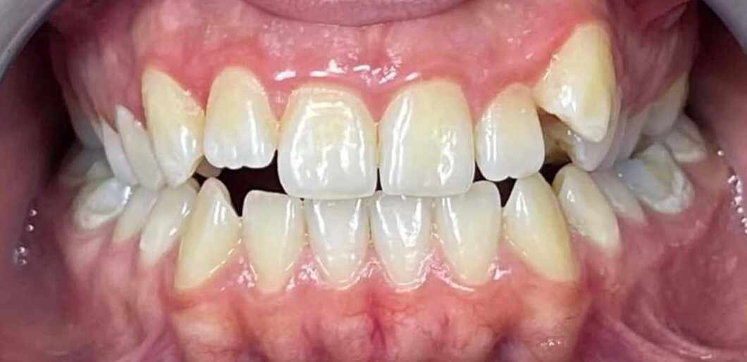 Before Braces Treatment