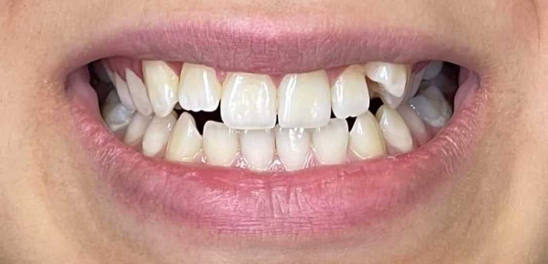 After Orthodontic Treatment and Aligners