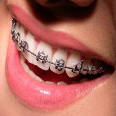 Dental Implant