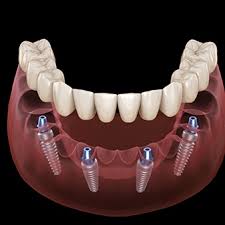 Dental Implant